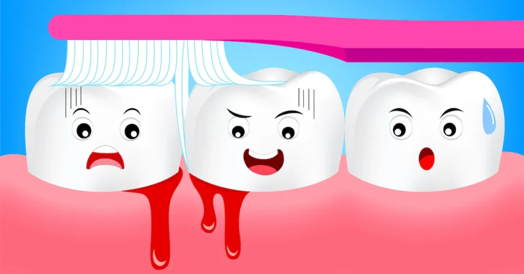 Is Bleeding Gums an Early Sign of Gum Disease Poole?