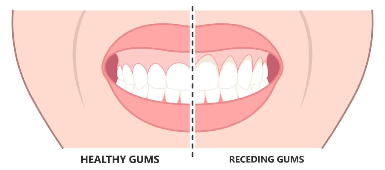 What Causes Gums to Recede Over Time Poole